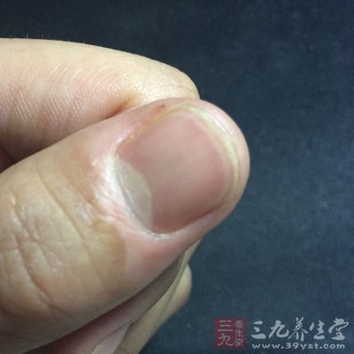 指甲出現白點(diǎn)或絮狀白斑 指甲出現白點(diǎn)或絮狀白斑
